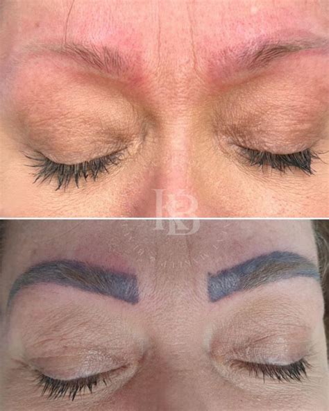 A Guide To Healing After Laser Eyebrow Tattoo Removal Kristina Bradley