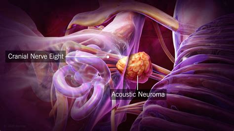 Best Acoustic Neuroma Treatment Options Revealed