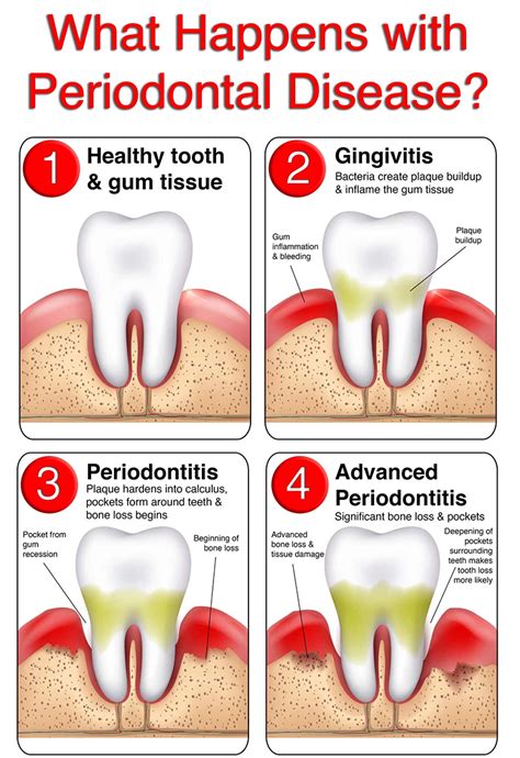 Advanced Tips for Gum Disease You Didn't Know