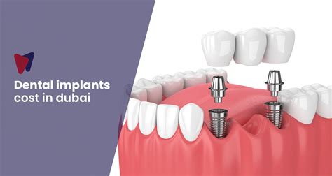All on 4 Dental Implants Cost Insights in Dubai