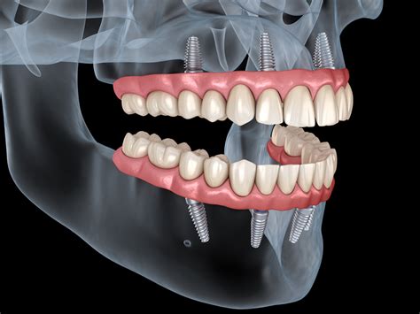 Exploring All on 4 Dental Implants Financing Options: Your Complete Guide