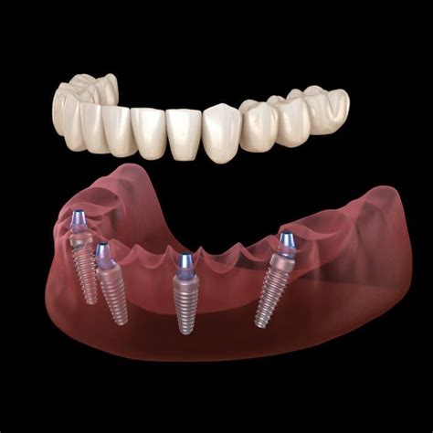Discover All-on-4 Dental Implants New York: Transform Your Smile Today