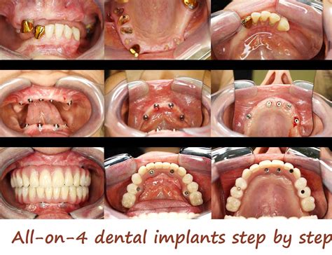 Top All on 4 Dental Implants: Expert Dentist Guide