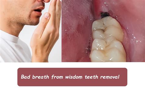 Bad Breath Remedies for Sensitive Teeth Relief