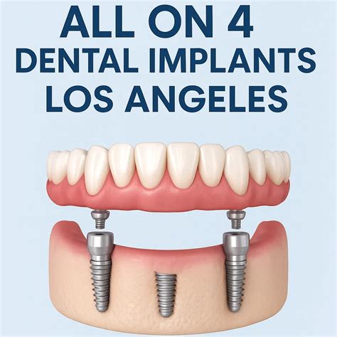 Discover the Best All on 4 Dental Implants in Los Angeles Today
