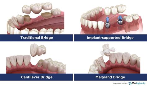 Best Dental Bridge Treatment in Toronto Revealed