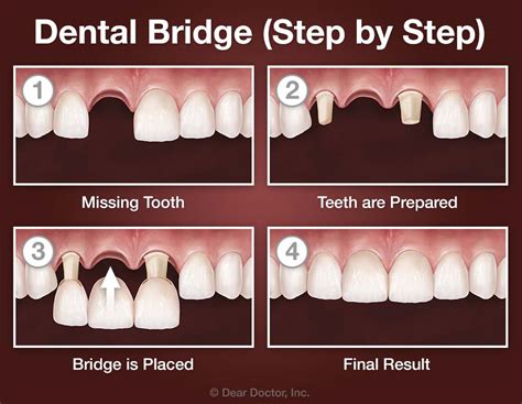 Best Dental Bridge Treatment UK: Top Choice Revealed