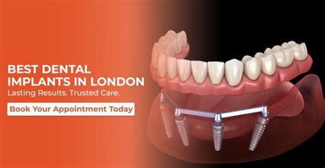 Top Choices for Best Dental Implants in UK