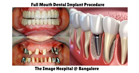 Best Full Mouth Dental Implants in Singapore Revealed