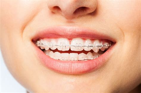 Discover Top Best Invisible Braces in USA Today