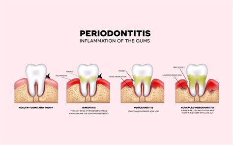 Top Periodontal Treatment in New York Revealed