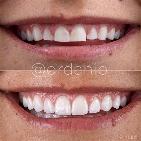 Discover Top-Rated Best Porcelain Veneers in Los Angeles