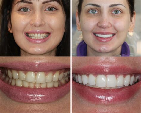 Top UK Dentist for Best Porcelain Veneers