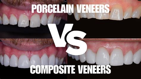 Top-Rated Best Porcelain Veneers in USA Revealed