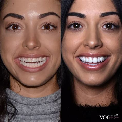 Best Smile Makeover in Canada: Transform Your Teeth!