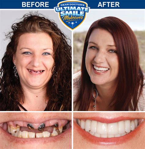 UK's Top Smile Makeovers Revealed