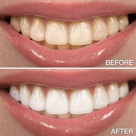 Best Teeth Whitening Treatment in Toronto Uncovered