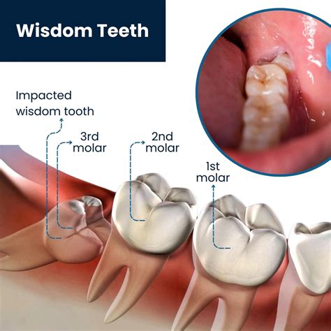 Top Best Wisdom Tooth Removal in Dubai