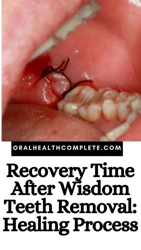 Top UK Practices for Best Wisdom Tooth Removal