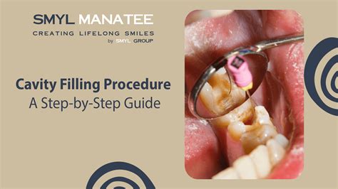 Cavity Prevention Step-by-Step Guide for Healthier Smiles