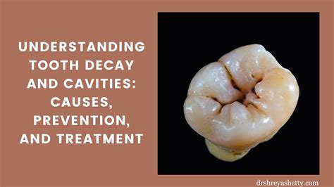 Top Cavity Prevention Treatment Secrets Revealed