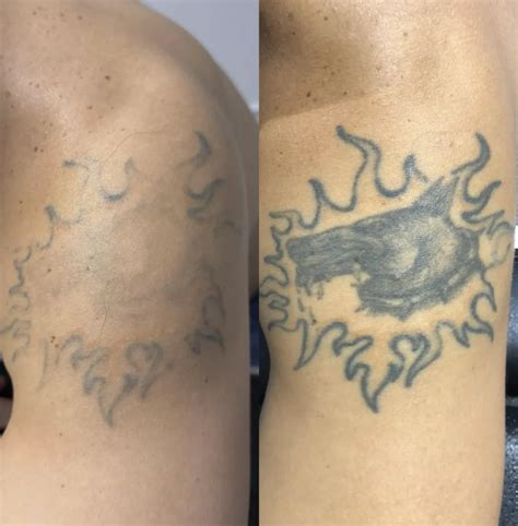 Complete Guide To Tattoo Removal Techniques And Costs