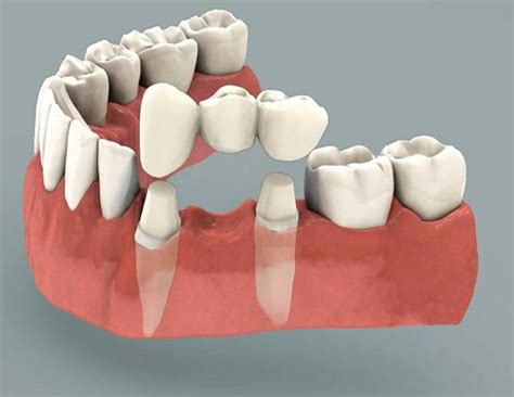Urgent Dental Bridge Treatment 24 Hour Service Available Now