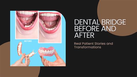 Dental Bridge Treatment Transformation: Before and After