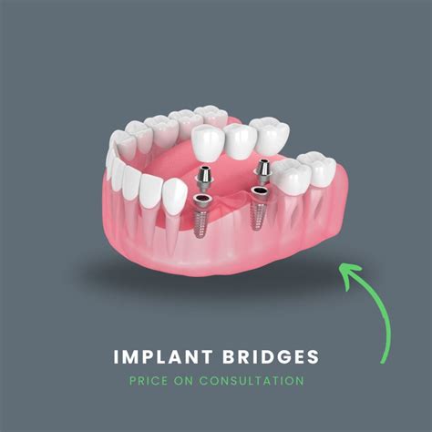 Dental Bridge Treatment Cost in London Explored