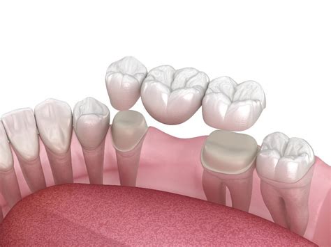 Best Dental Bridge Treatment in Los Angeles