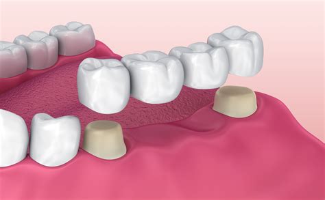 Top-Rated Dental Bridge Treatment Near Me