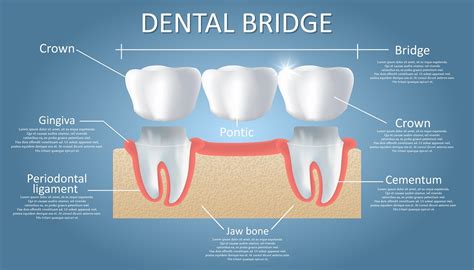 Top Dental Bridge Treatment Specialist Guide
