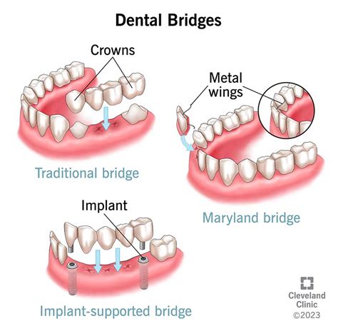 Top Dental Bridge Treatment by Leading Dentist Near You