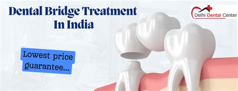 Dental Bridge Treatment Cost: Best Affordable Options