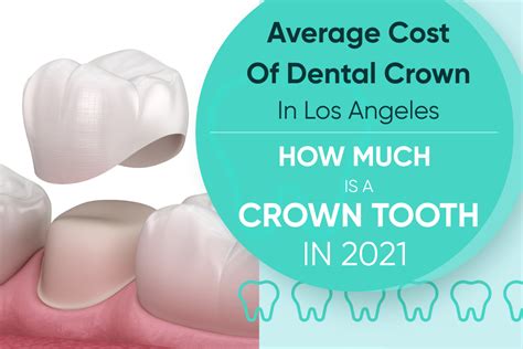 Dental Crown Cost Los Angeles: Find Affordable Options