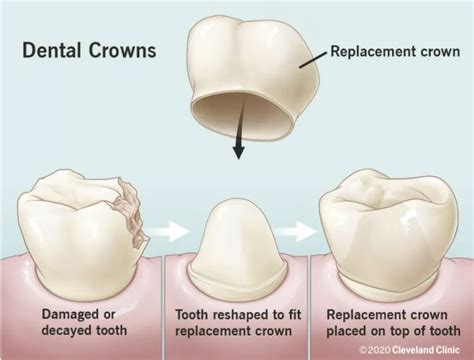 Dental Crown Cost Singapore: Affordable Care Revealed!