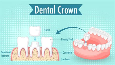 Top-Rated Dentist Reveals Affordable Dental Crown Cost