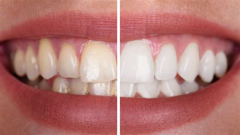 Dental Health Before and After: Stunning Transformations Revealed