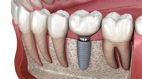 Dental Implants 24 Hour Service: Quick and Painless Solutions