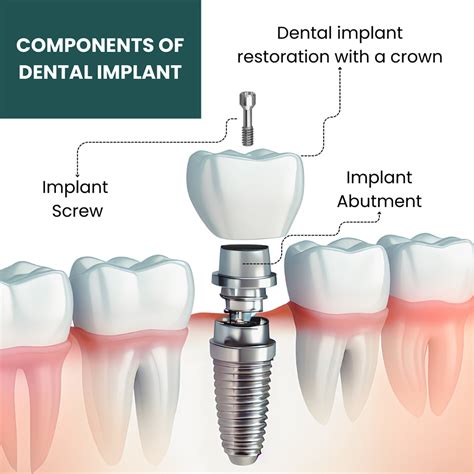 Best dental implants top dentist near you