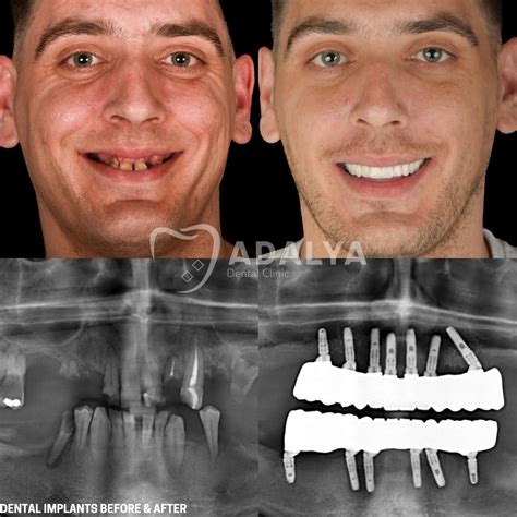 Amazing Dental Surgery Results: Real Patient Transformations Revealed!