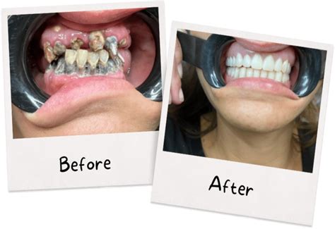 Dental Treatment Before and After Transformation: Real Patient Success Stories Unveiled