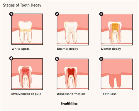 Early Signs of Dental Treatment Uncovered