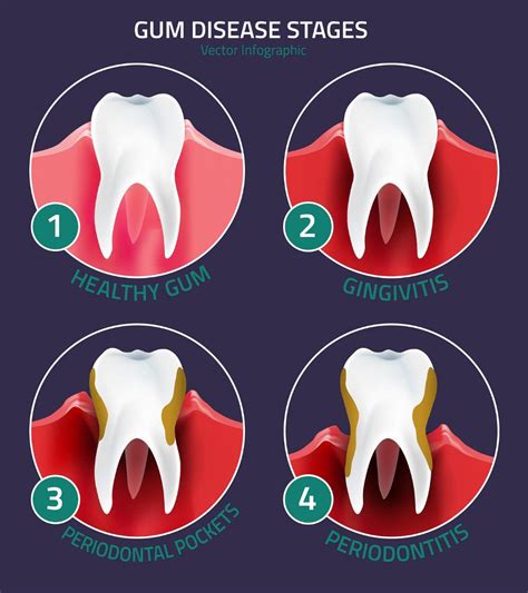 Early Warning Signals of Gum Disease You Shouldnt Ignore