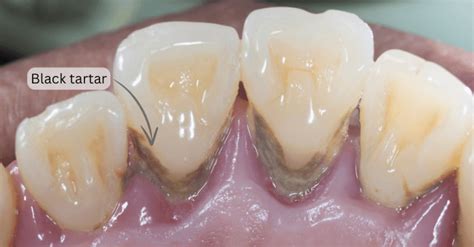 Early Signs of Effective Tartar Removal