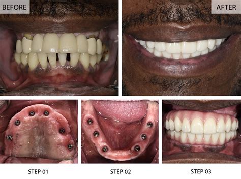 Full Mouth Dental Implants Before and After: Stunning Transformations Revealed