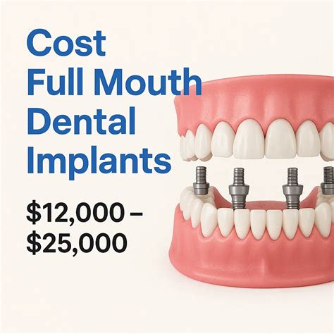 Full Mouth Dental Implants: Expert Guide
