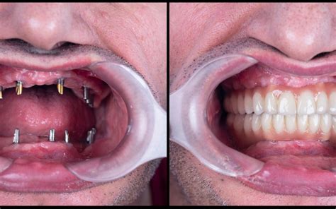Full Mouth Dental Implants Long Lasting Results Explored