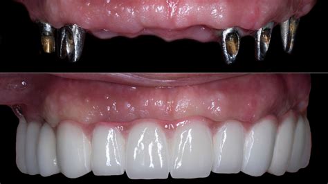 Full Mouth Dental Implants UK: Transform Your Smile