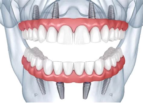 Full Mouth Dental Implants USA: Transformative Solutions Uncovered